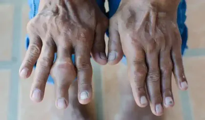 Gut hastalığı, ishal şikayeti, romatizma ağrıları... Hepsinin çaresi kantaron yağında!