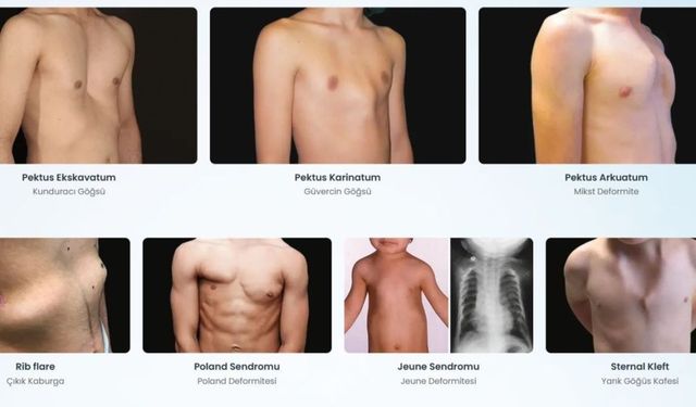 Pektus’tan bir cihazla kurtulabilecek çocuklar, sistem engeline takılıyor: Devlet ameliyatı ödüyor, tedaviyi değil!
