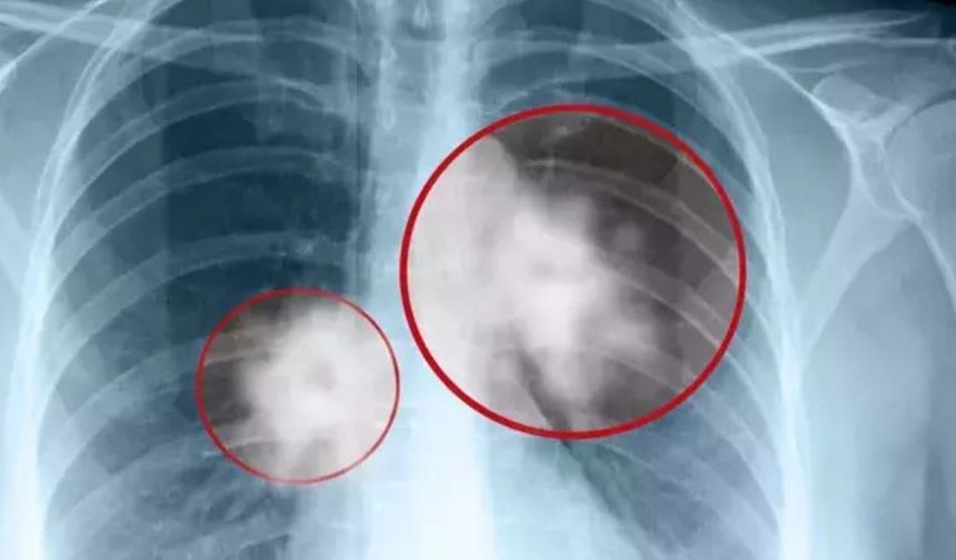 Akciğerdeki iltihabı silgi gibi siliyor! Her gün bir bardak içmek yetiyor