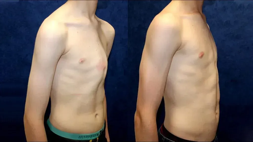 2. Bölüm: Pektus tedavisinde yeni dönem! “Kapalı ameliyatla tam iyileşme mümkün”