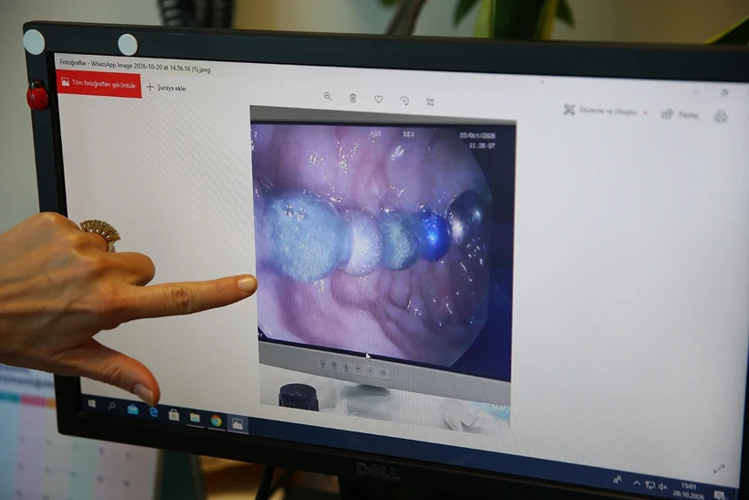 Çocuklarda yabancı cisim yutma vakaları artıyor! Uzmandan ailelere pil ve mıknatıs uyarısı
